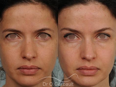 lifting du visage 👩 paris chirurgie de rajeunissement facial