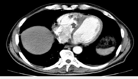 Ct Scan Of The Chest With Iv Contrast Showing Lobulated Mass Within The