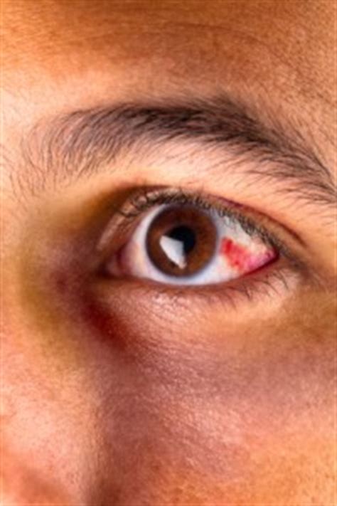 Usually, if the whites of the eyes have squiggly red veins in them, it is due to tiredness, lack of sleep, viral infection or irritation. Red Eye | Parrelli Optical
