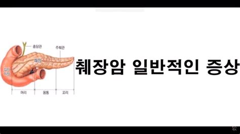 .gastrointestinal endoscopy 내시경초음파 유도하 복강신경얼기 박리술 시행 후 마약 금단증상을 보인 췌장암 1예 a case of pancreatic cancer and opioid withdrawal after 금단증상을 보인 췌장암 1예. 췌장암 일반적인 증상 - YouTube