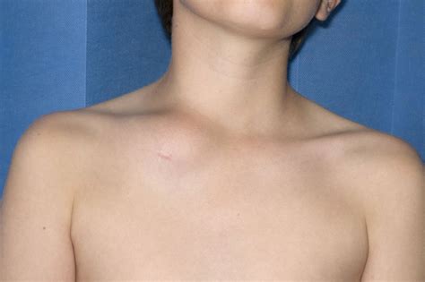 Clavicular Swelling—classic Presentation Of Chronic Non Bacterial