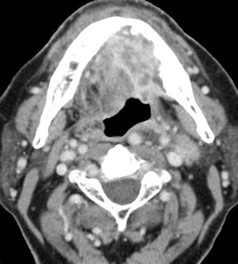 Squamous Cell Carcinoma Of The Oral Cavity Radiology Case