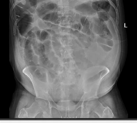 Abdominal X Ray Showed Diffuse Ileus Download Scientific Diagram