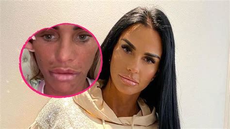 Täglich bestens informiert aus erster hand! Fieser Botox-Fail! Katie Price konnte nicht mehr lächeln ...