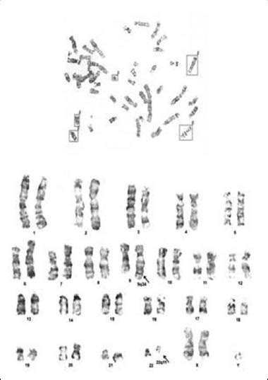Cytogenetic Study Shows 47 Xxy Karyotype With Philadelphia Chromosome