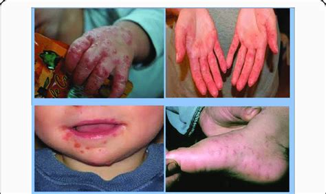 signs of hand foot and mouth disease