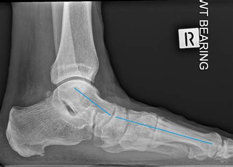 Flat Foot Reconstruction Tips For A Smooth Recovery