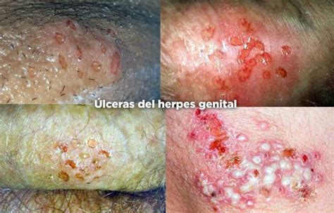 Herpes Genital Qu Es S Ntomas Y Tratamiento Md Sa De