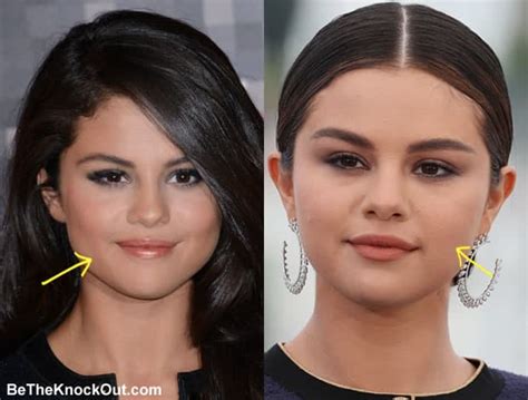 selena gomez plastic surgery comparison photos