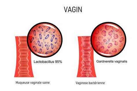 Gardnerella Vaginalis What Is It And How To Treat It Earth Press News