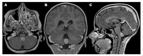 Incidental Findings On Brain Magnetic Resonance Imaging Mri In