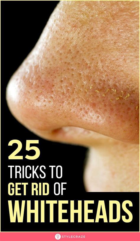 14 Effective Ways To Treat Whiteheads Face Health Whiteheads Beauty