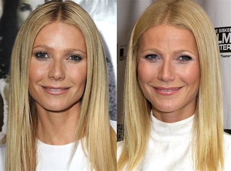 Photos From Better Or Worse Celebs Who Have Had Plastic Surgery E