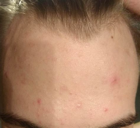 Mild Acne Compared To Some Here But Its Been Bugging Me For Years