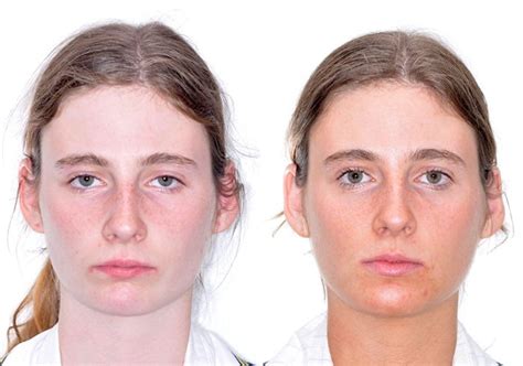 Case 15 Lower Jaw Surgery Sydney Oral And Facial Surgery