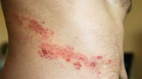 Is It Shingles Or Something Else Everyday Health