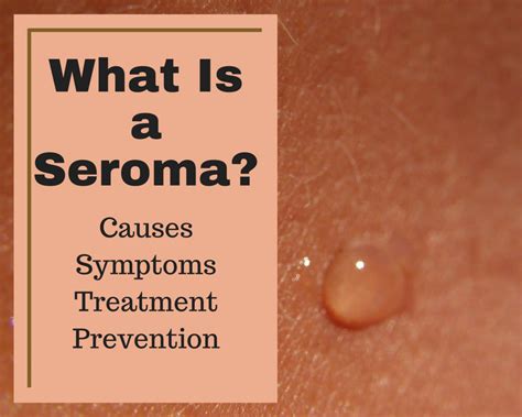 Seroma Causes Symptoms Treatment And Prevention Youmemindbody