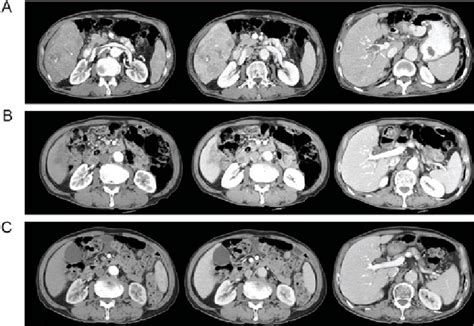 Multiphasic Contrast Enhanced Ct Of The Abdomen A Initial Abdominal
