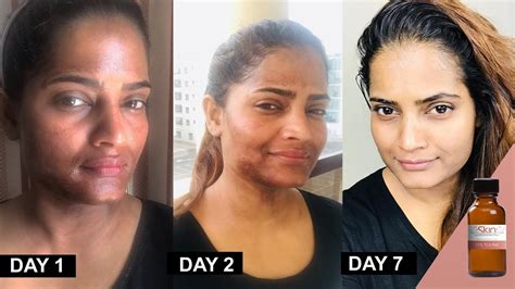 Chemical Peel At Home Before And After 25 Tca Peel Diary Makeup