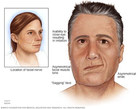Bell's palsy is a peripheral nerve effect whereas a ischemic stroke is a central process. Bell's palsy Disease Reference Guide - Drugs.com
