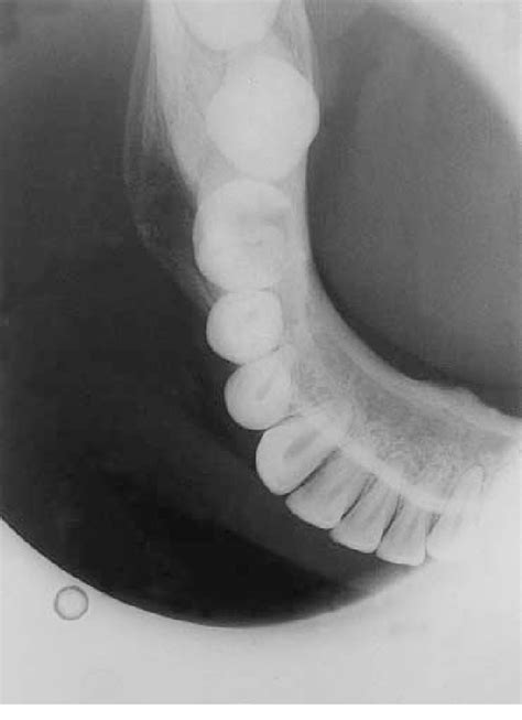 Occlusal View Of The Right Mandible In Case 1 Showing Fusiform Buccal