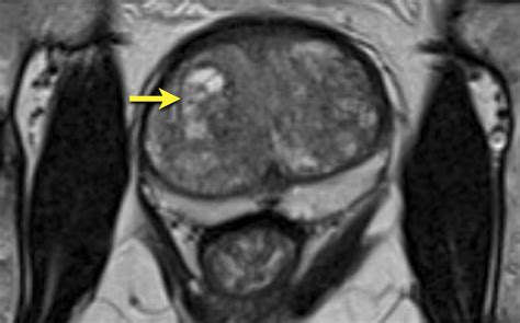 Pdf Mri Prosztata Normal Prostate Gland Mri