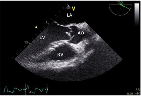 Transesophageal Echocardiography Shows A Vegetation On Open I