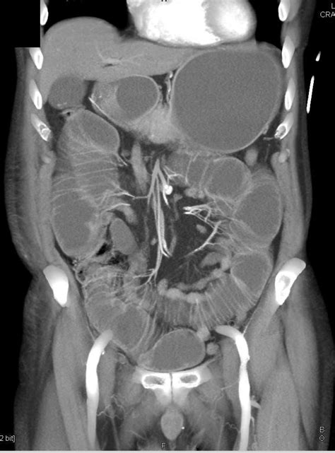 Small Bowel Obstruction Sbo Due To Bowel Trapped In A Inguinal Hernia