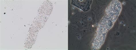 Urine Sediment Of The Month Pigmented Casts What Those Pretty Colors