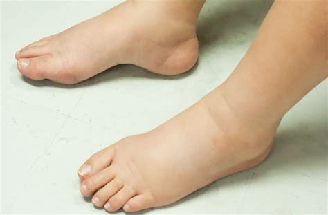 Θρομβωση θρομβωση αιματοσ θρομβωση παραγοντεσ κινδυνου θρομβωση στο ποδι συμπτωματα θρομβωση συμπτωματα. Why Do You Have Swollen Feet and Ankles? | Wellness | US News