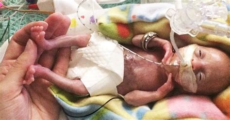 Premature Baby Born At 22 Weeks Newborn Baby