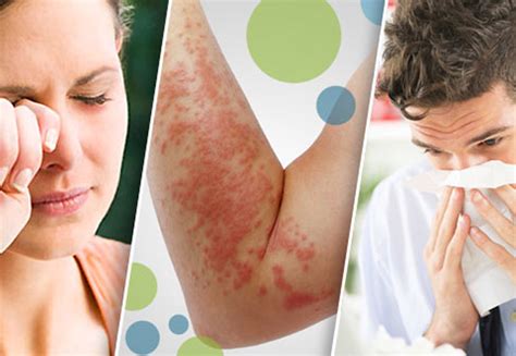 Alergias Lo Que Debes Saber