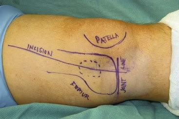 70 Medial Femoral Condyle Vascularized Bone Flap For Scaphoid Nonunion