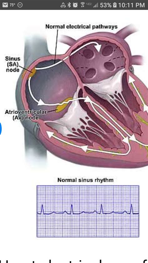 Ectopic Atrial Tachycardia —