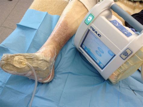 Diabetic Foot Ulcer Treated By Negative Pressure Wound Therapy