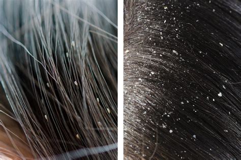 How To Spot The Difference Between Lice And Dandruff Readers Digest
