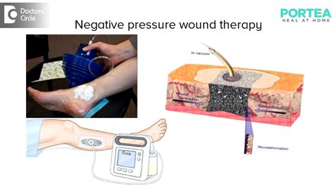 To help promote healing from hospital to home, cardinal health™ has a portfolio of negative pressure wound therapy (npwt) devices and disposables to meet your patients' needs across the continuum of care. What is meant by negative pressure wound therapy? | Portea ...