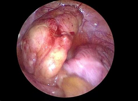 Apendiks adalah organ yang terletak di bahagian kanan perut di sebelah bawah. Appendicitis pada kanak-kanak - apakah itu dan bagaimana ...