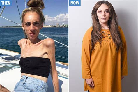 Ex Anorexic Who Nearly Died After Her 100 Calorie A Day Diet Made Her Drop To Four Stone Makes