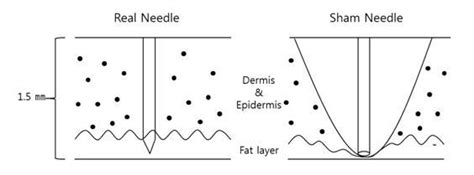 New Development In Sham Acupuncture Needle Intechopen