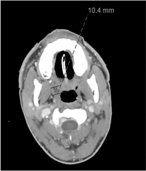 Ct Neck With Contrast Showing A 14 Cm Right Peritonsillar Abscess
