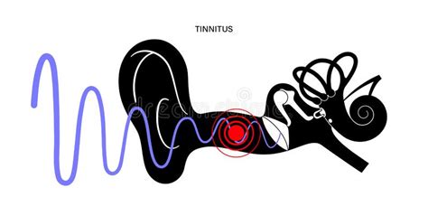 Tinnitus Pain Stock Illustrations 227 Tinnitus Pain Stock