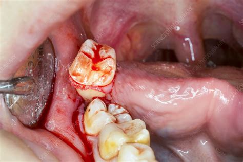 How To Find Out If You Want Knowledge Tooth Extraction