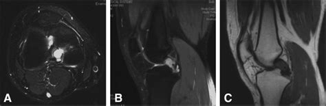 Mri Of The Intra Articular Lesion In The Right Knee A T2 Weighted