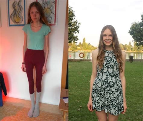 Anorexic Girl Inspires People To Get Healthy After Being Days Away From