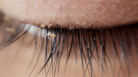 Doctors Warn About Lash Lice Becoming More Common In Eyelash Extensions Abc7 New York