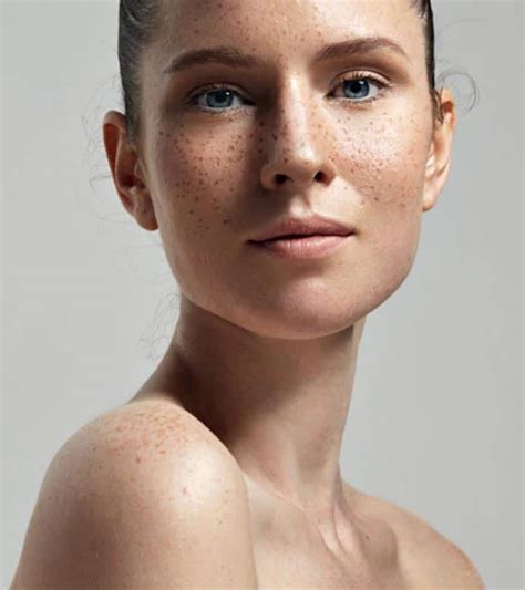 How To Get Rid Of Freckles All You Need Infos
