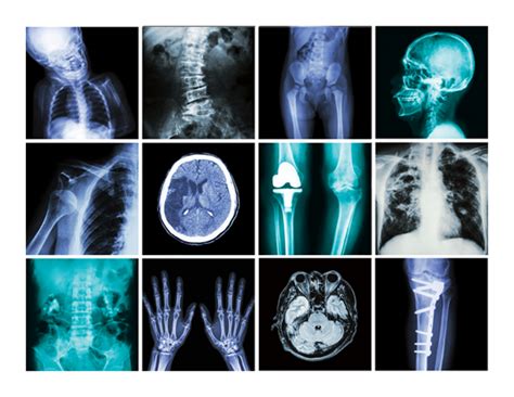 When to Question X-rays and CT Scans - Consumer Reports