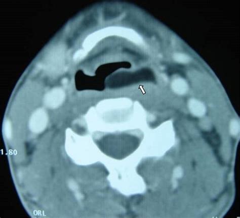 Axial Ct Scan Of The Neck Revealed A Well Defined Mass Of A Very