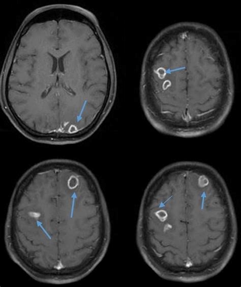 Brain Damage Following Cerebral Abscess Seven Months Ago Myleskruwrivera